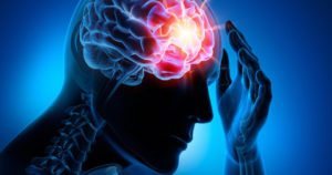 Epilepsy