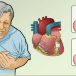 Coronary Artery Disease and Angina